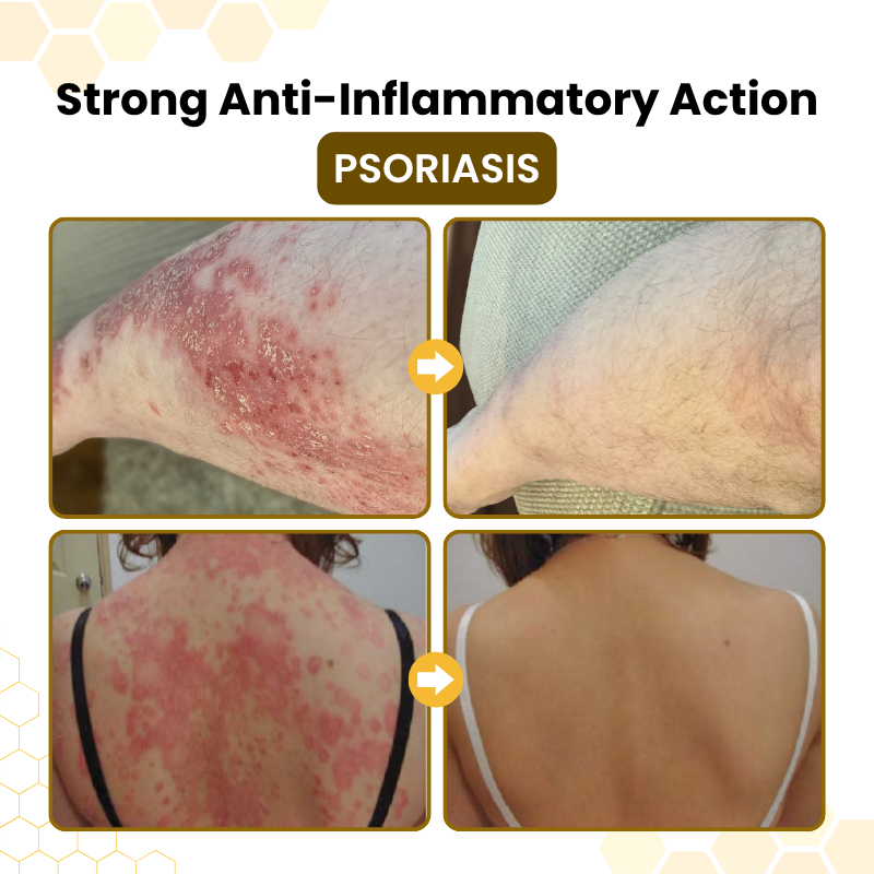 Last Day Of Discount 🔥 PsoriaSoothe Skin Care Cream.