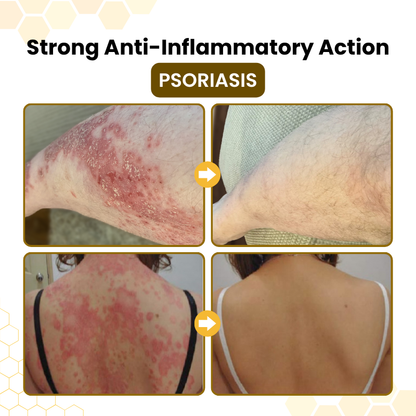 Last Day Of Discount 🔥 PsoriaSoothe Skin Care Cream.